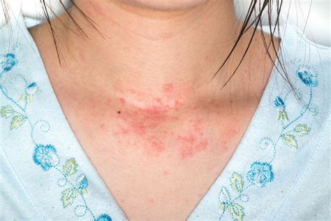 How To Address Skin Problems Related To Allergies?